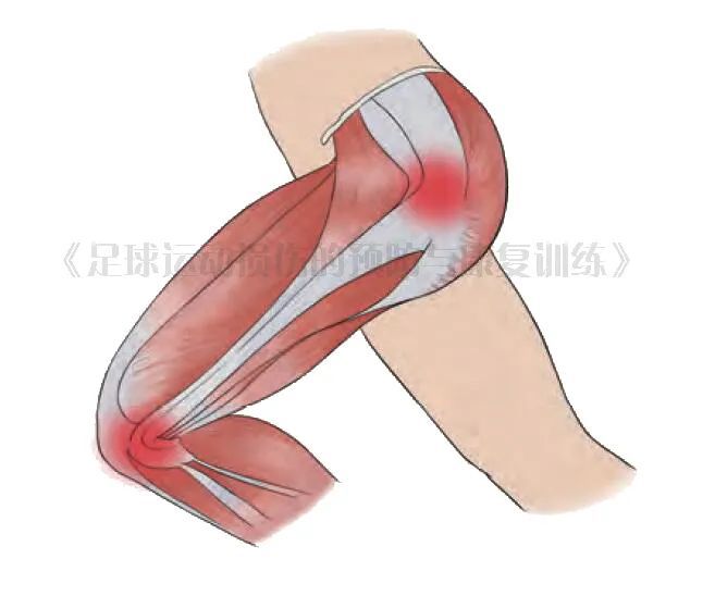 【髂胫束摩擦综合征】一动膝外侧就痛？一篇文助你解决运动硬伤！